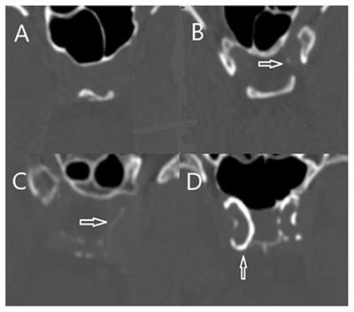 Correlation Between Intracranial Carotid Artery Calcification and Prognosis of Acute Ischemic Stroke After Intravenous Thrombolysis